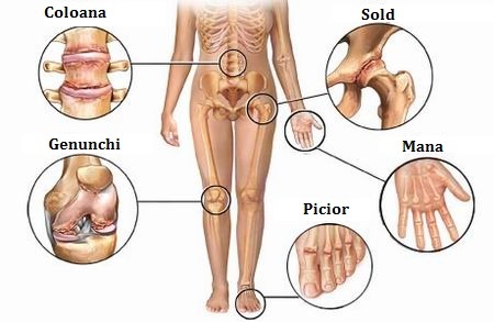 lista de unguente pentru articulații artrita simetrica